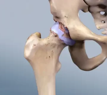 دوتا استخوان لگن که آرتروز دارند و به هم متصل شده اند