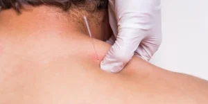 dry-needling-vs-acupuncture